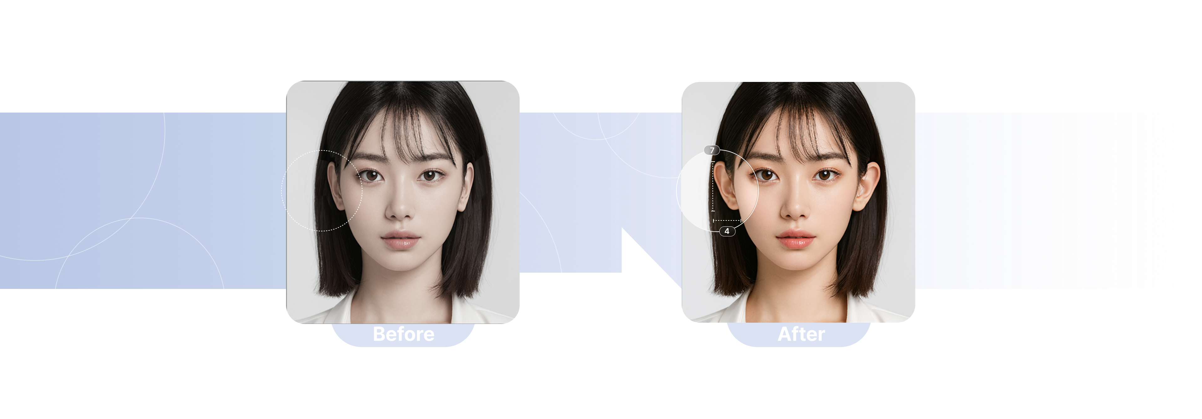 귀필러 시술 전후 비교